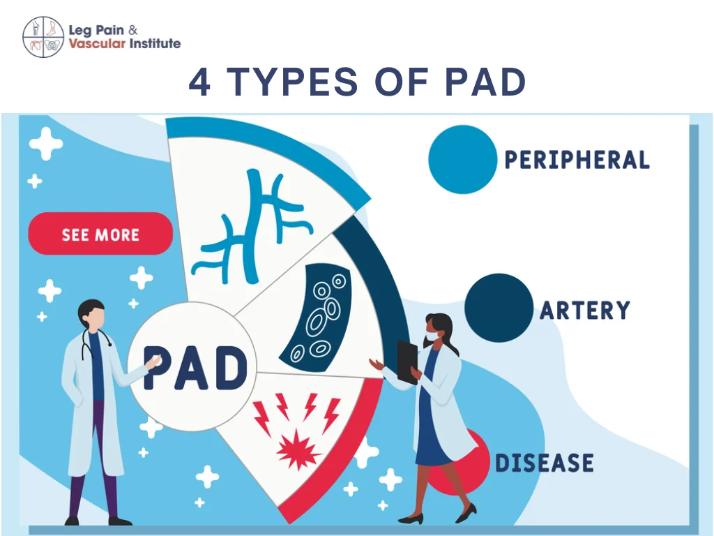 4 Types of Peripheral Arterial Disease You Should Know