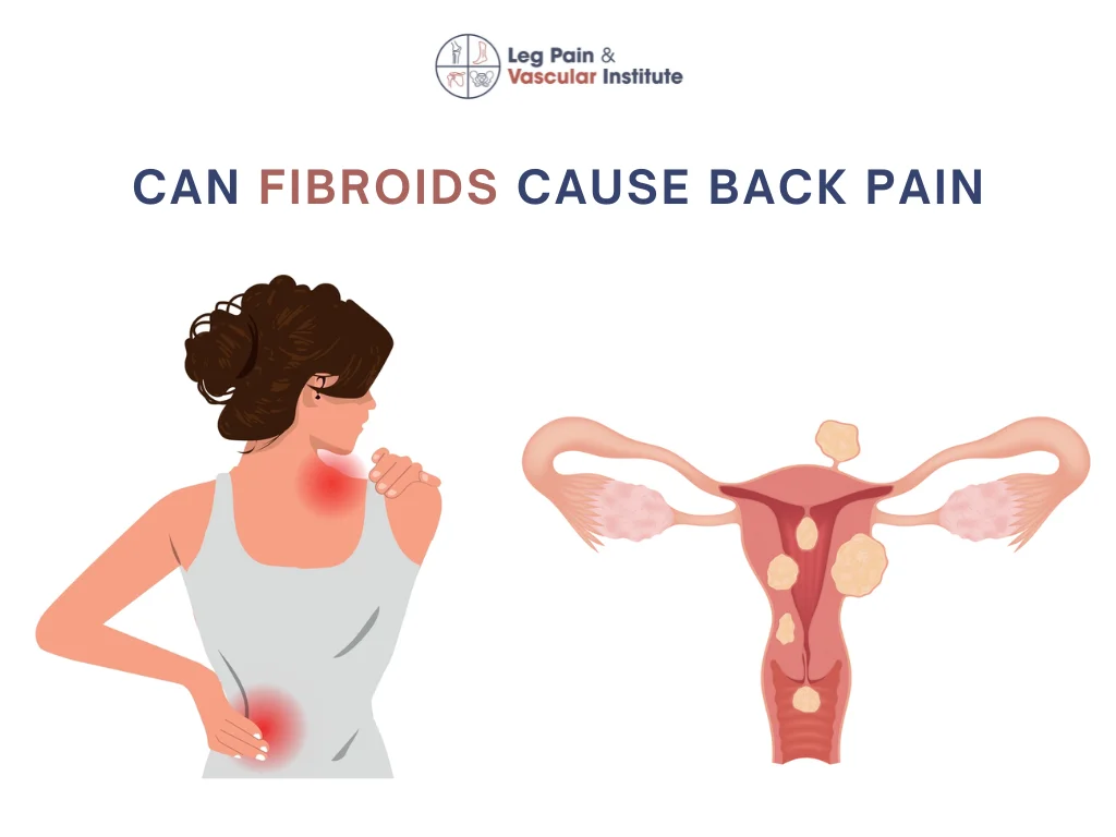 Can Uterine Fibroids Cause Back Pain?