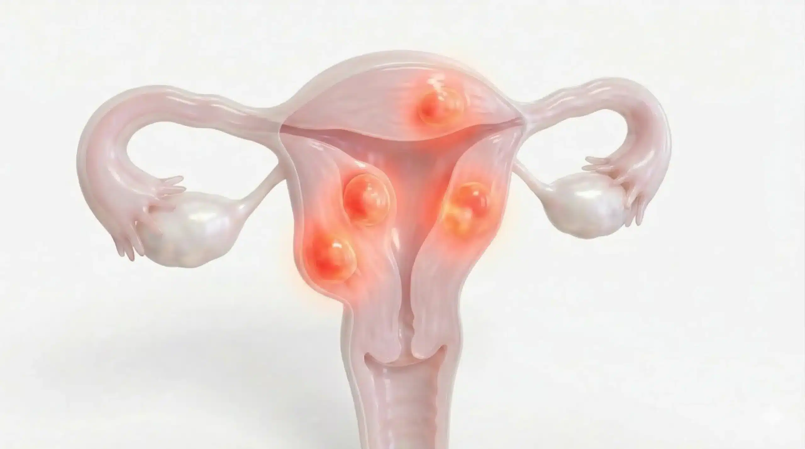 Uterine Fibroids (UFE)